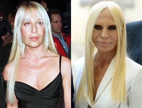 que le paso a donatella versace|donatella versace before and after surgery.